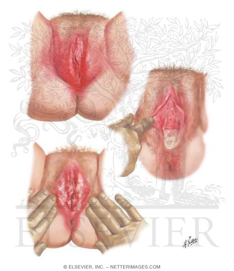 Vulvitis I - Diabetes, Trichomoniasis, Moniliasis
