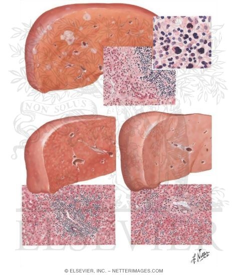 Watermarked preview of unlabeled image: Hodgkin's Disease, Leukemia