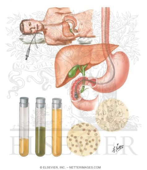 Watermarked preview of unlabeled image: Duodenal Drainage of Meltzer and Lyon