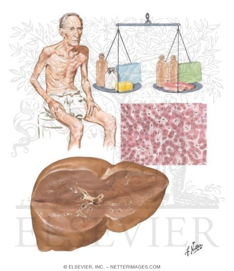 Watermarked preview of unlabeled image: Nutritional Liver Diseases
