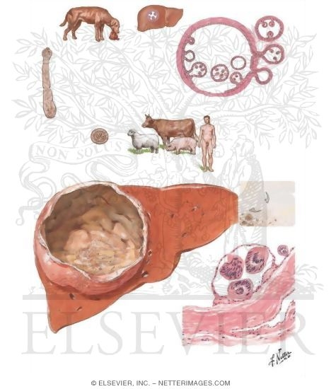 Echinococcus Cyst (Hydatid Disease)