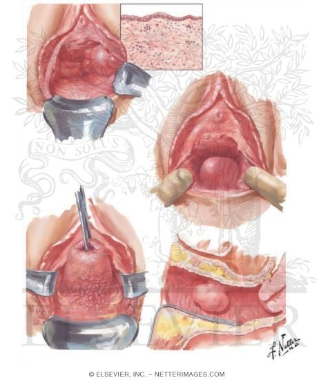 Cysts and Benign Tumors
Vaginal Cysts