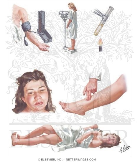 Acute Toxemia of Pregnancy I - Symptomatology of Preeclampsia and Eclampsia