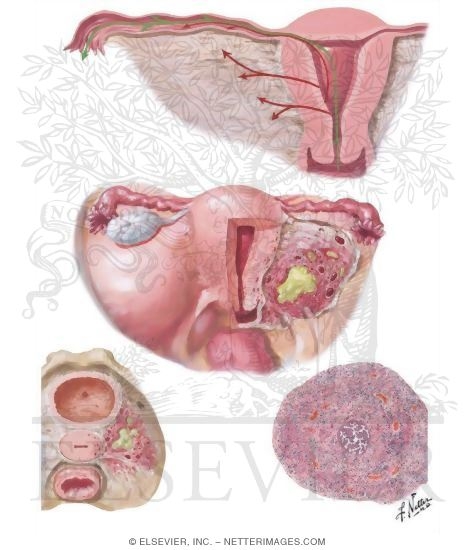 Illustration of Pathways of Infection, Parametritis, Acute Salpingitis I
Endometritis from the Netter Collection