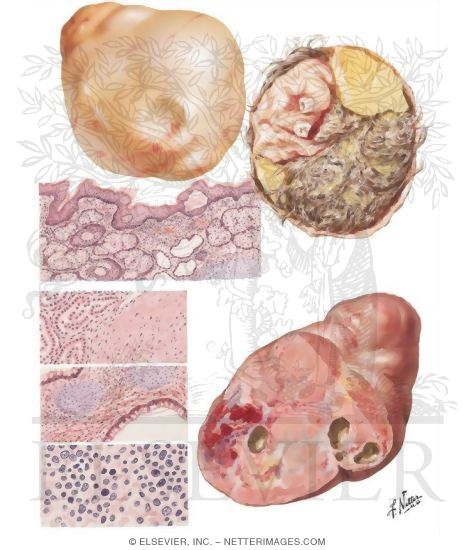 Teratoma, Dermoid Cyst, Solid Teratoma