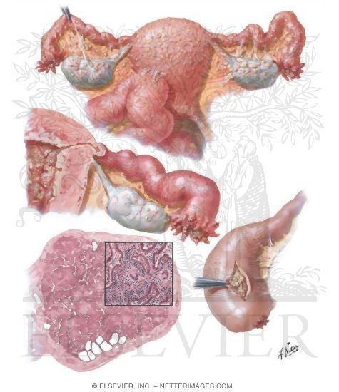 Watermarked preview of unlabeled image: Tuberculosis
