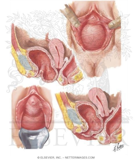 Cystocele, Urethrocele