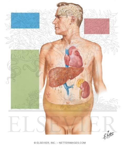 Ascites - Pathogenesis
