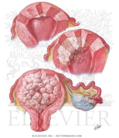 Watermarked preview of unlabeled image: Cancer of Corpus I - Various Stages and Types