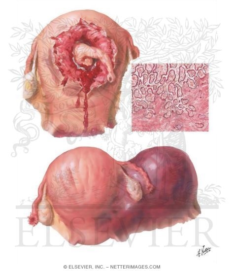 Rupture of Uterus