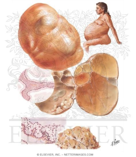 Pseudomucinous Cystadenoma