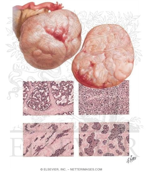 Watermarked preview of unlabeled image: Carcinoma - Primary Cystic Carcinoma, Primary Solid Carcinoma, Secondary Ovarian Carcinoma