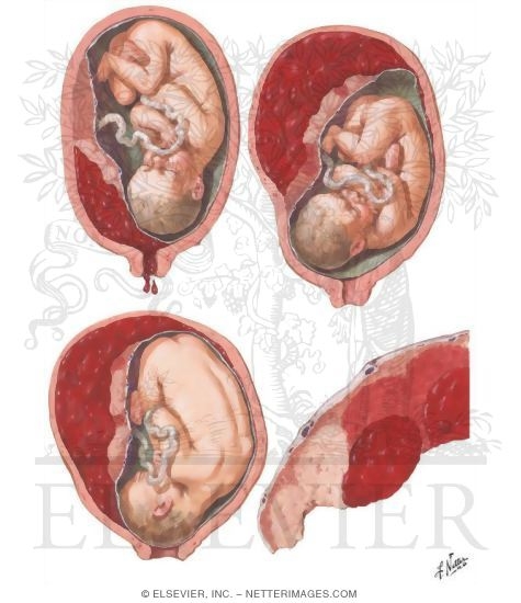 Watermarked preview of unlabeled image: Placental Abruption
