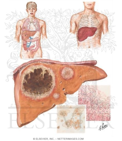 Amebiasis