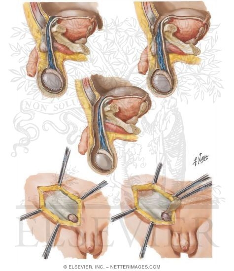 Anomalies of the Processus Vaginalis