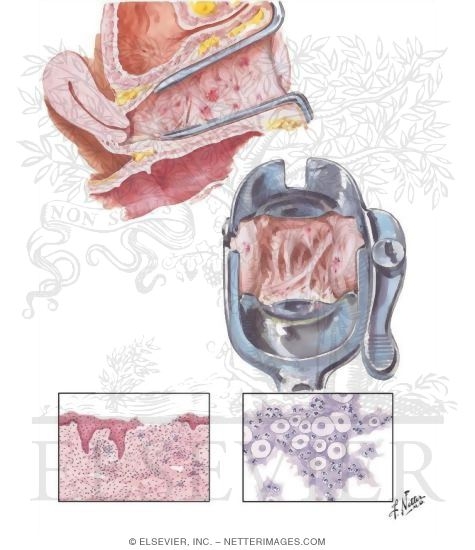 Atrophic Conditions
Vaginal Dryness
