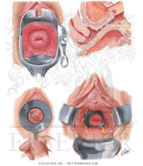 Vaginitis III, Chemical, Traumatic