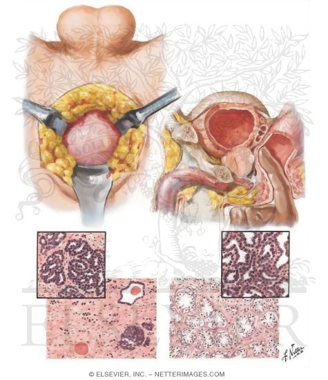 Carcinoma of Prostate III - Early, Estrogen and Castration Effects