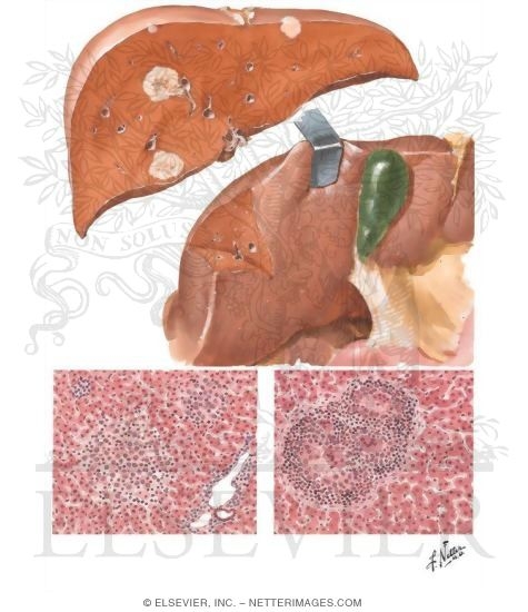 Watermarked preview of unlabeled image: Tuberculosis