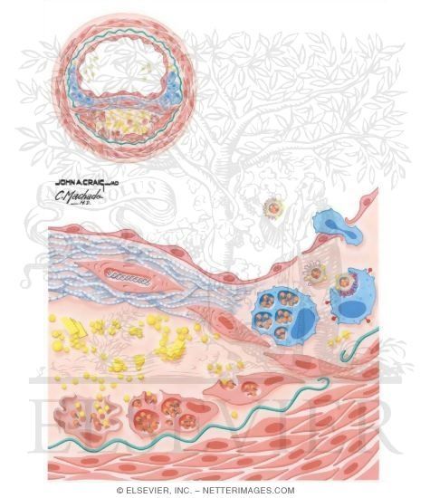 Watermarked preview of unlabeled image: Atherosclerosis (Continued)