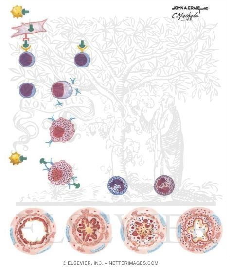 Watermarked preview of unlabeled image: Pathogenesis of Asthma