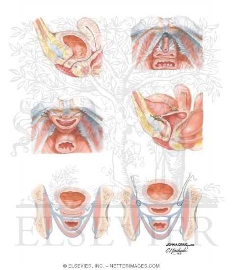 Watermarked preview of unlabeled image: Surgical Management of Urinary Incontinence