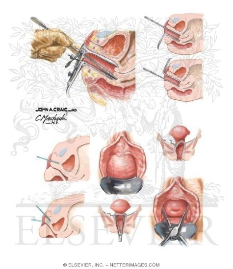Speculum Examination
