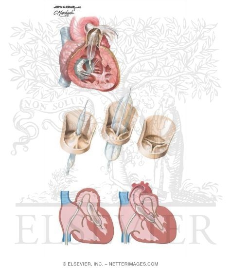 Balloon Valvuloplasty, Mitral Valve