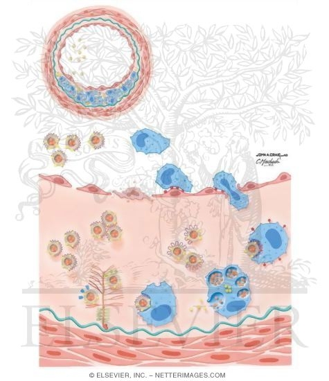 Watermarked preview of unlabeled image: Atherosclerosis