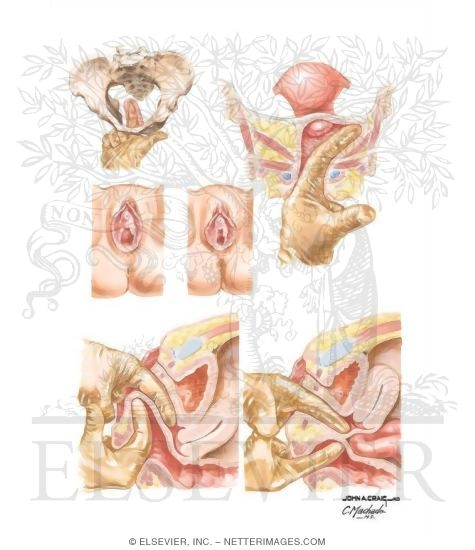 Watermarked preview of unlabeled image: Palpation of Pelvic Structures