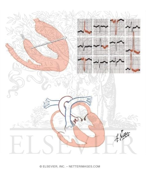 Left Ventricular Hypertrophy