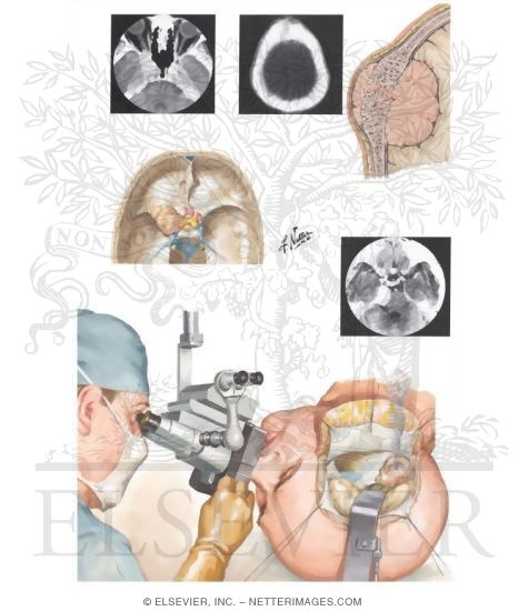 Meningiomas