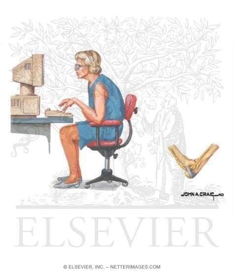 Watermarked preview of unlabeled image: Compression Neuropathy In Workplace