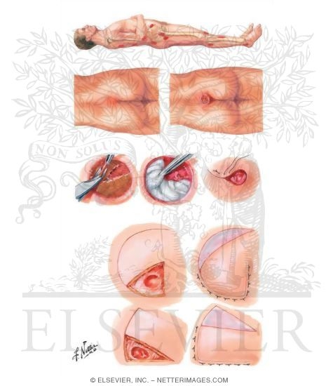 Watermarked preview of unlabeled image: Pressure Ulcer