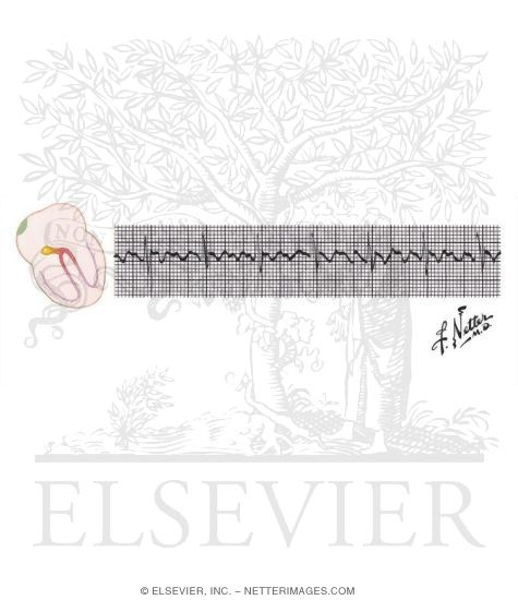 Atrial Flutter