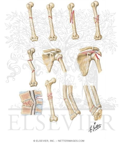 Types of Fracture