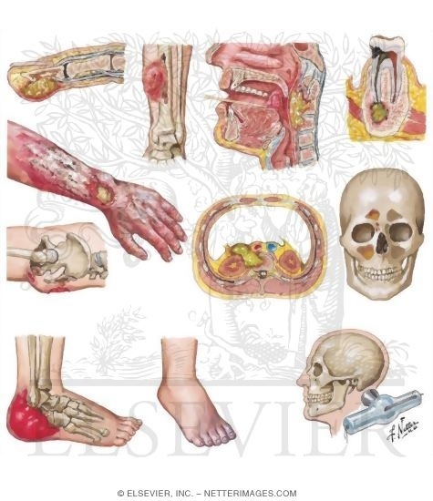 Watermarked preview of unlabeled image: Direct (Nonhematogenous) Causes of Osteomyelitis