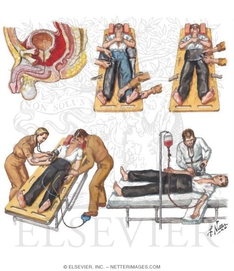 Watermarked preview of unlabeled image: Prehospital Care of Fracture of Pelvis