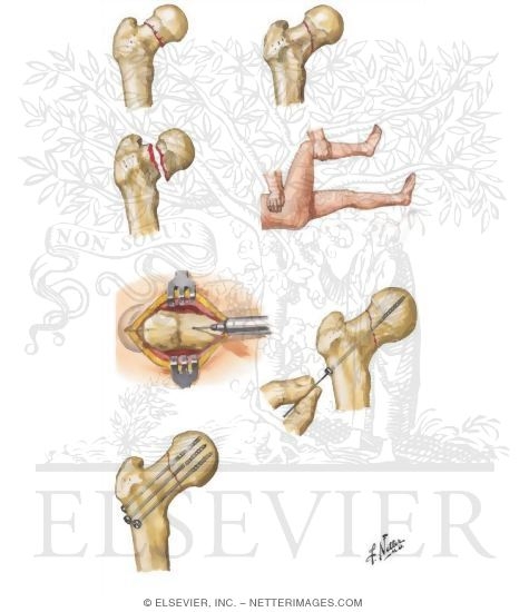 Intracapsular Fracture of Femoral Neck