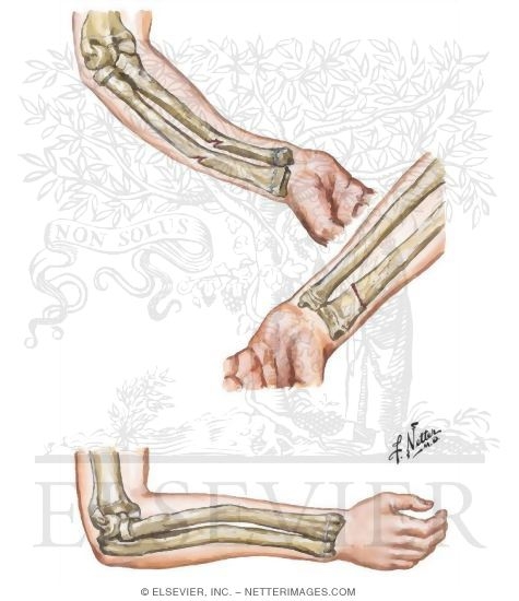 Incomplete Fracture in Children
