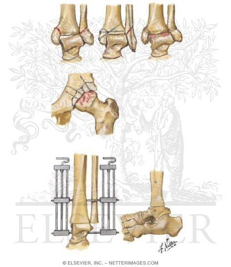 Watermarked preview of unlabeled image: Posttraumatic Osteoarthritis