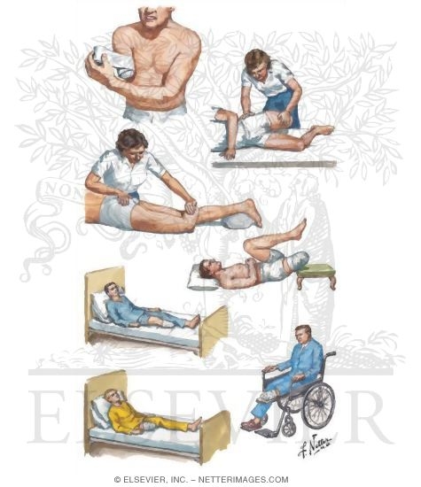 Watermarked preview of unlabeled image: Rehabilitation After Amputation