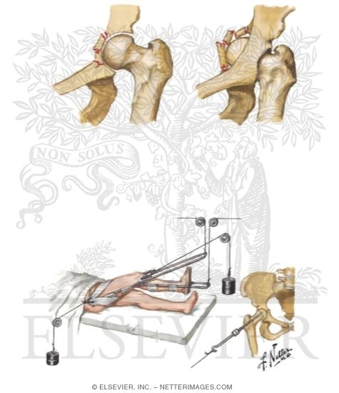 Watermarked preview of unlabeled image: Posterior Dislocation of Hip