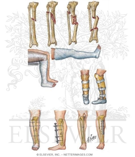 Fracture of Shaft of Tibia
Trauma of the Leg and Knee