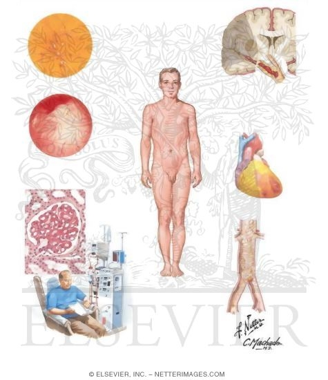 Diabetes Mellitus and Its Complications: Micro and Macrovascular Complications