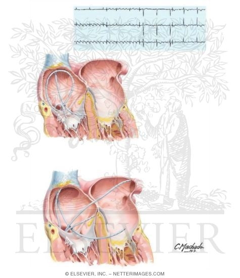 Atrial Flutter, Atrial Tachycardia, and Atrial Fibrillation