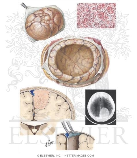 Meningiomas