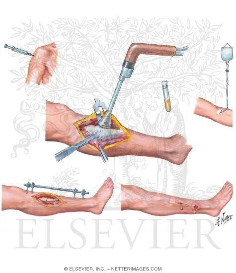 Watermarked preview of unlabeled image: Surgical Management of Open Fractures