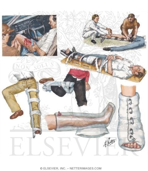 Watermarked preview of unlabeled image: Prehospital Care of Fracture of Lower Limb