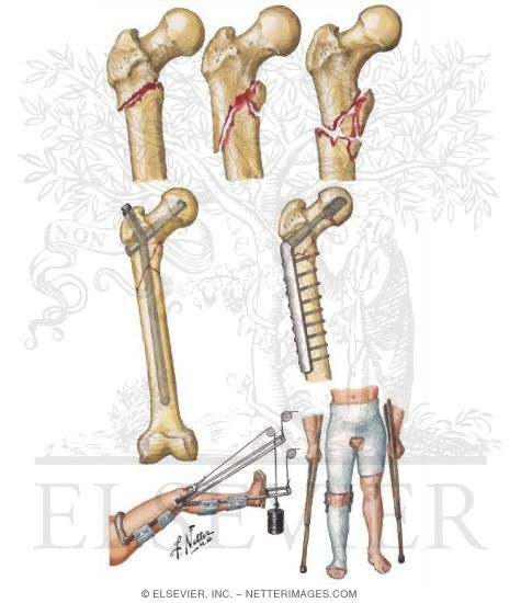 Subtrochanteric Femoral Fracture